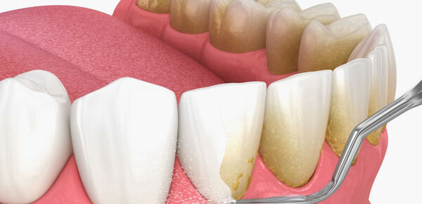Вред зубного камня: почему его важно удалять и как это сделать